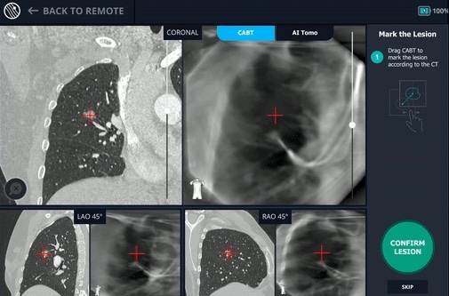 biopsy-and-diagnosis-of-9mm-nodule-in-right-middle-lobe-bodyvision